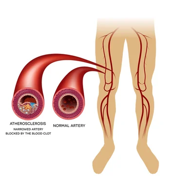 Circulatory problems